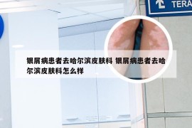 银屑病患者去哈尔滨皮肤科 银屑病患者去哈尔滨皮肤科怎么样