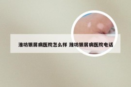 淮坊银屑病医院怎么样 潍坊银屑病医院电话
