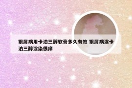 银屑病用卡泊三醇软膏多久有效 银屑病涂卡泊三醇涂染很痒