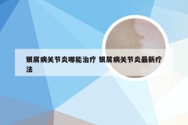 银屑病关节炎哪能治疗 银屑病关节炎最新疗法
