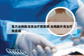 复方水杨酸溶液治疗银屑病 水杨酸外用治疗银屑病