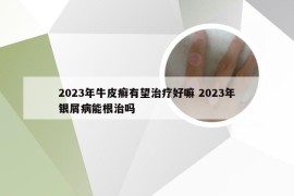 2023年牛皮癣有望治疗好嘛 2023年银屑病能根治吗