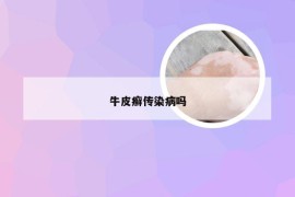 牛皮癣传染病吗