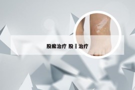 股廨治疗 股廯治疗