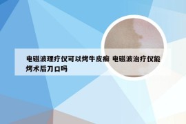 电磁波理疗仪可以烤牛皮癣 电磁波治疗仪能烤术后刀口吗