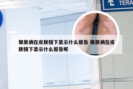 银屑病在皮肤镜下显示什么报告 银屑病在皮肤镜下显示什么报告呢