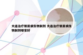 大连治疗银屑病生物制剂 大连治疗银屑病生物制剂哪家好