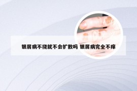银屑病不挠就不会扩散吗 银屑病完全不痒