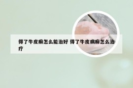 得了牛皮癣怎么能治好 得了牛皮病癣怎么治疗