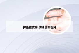 传染性皮癣 传染性癣图片