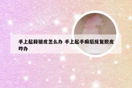手上起藓褪皮怎么办 手上起手癣后反复脱皮咋办