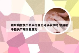 银屑病性关节炎手指变形可以手术吗 银屑病手指关节痛而且变形