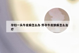 孕妇一头牛皮癣怎么办 怀孕牛皮肤癣怎么治疗
