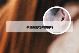 牛皮癣能吃弥猴桃吗