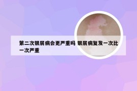 第二次银屑病会更严重吗 银屑病复发一次比一次严重