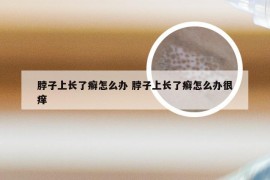 脖子上长了癣怎么办 脖子上长了癣怎么办很痒