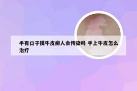 手有口子摸牛皮癣人会传染吗 手上牛皮怎么治疗