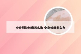 全身到处长癣怎么治 全身长癣怎么办