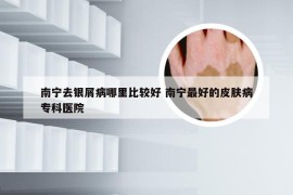 南宁去银屑病哪里比较好 南宁最好的皮肤病专科医院