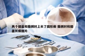 两个膝盖和胳膊肘上长了圆形癣 胳膊肘和膝盖长癣图片