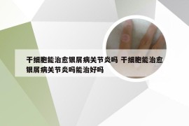 干细胞能治愈银屑病关节炎吗 干细胞能治愈银屑病关节炎吗能治好吗