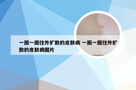 一圈一圈往外扩散的皮肤病 一圈一圈往外扩散的皮肤病图片