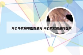 海口牛皮癣哪医院最好 海口皮肤病最好医院