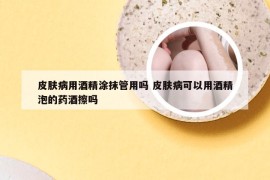 皮肤病用酒精涂抹管用吗 皮肤病可以用酒精泡的药酒擦吗