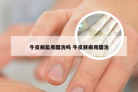 牛皮癣能用醋洗吗 牛皮肤癣用醋洗