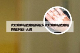 皮肤瘙痒起疙瘩越抓越多 皮肤瘙痒起疙瘩越抓越多是什么病