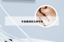 牛皮癣误食几块牛肉