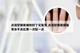 点滴型银屑病快好了又复发 点滴型银屑病复发会不会比第一次轻一点