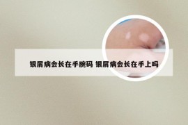 银屑病会长在手腕码 银屑病会长在手上吗