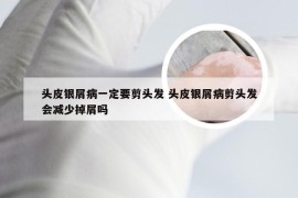 头皮银屑病一定要剪头发 头皮银屑病剪头发会减少掉屑吗