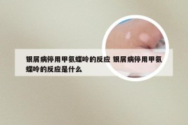 银屑病停用甲氨蝶呤的反应 银屑病停用甲氨蝶呤的反应是什么
