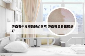 济南看牛皮癣最好的医院 济南哪里看银屑病好