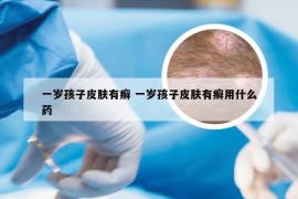 一岁孩子皮肤有癣 一岁孩子皮肤有癣用什么药