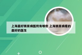 上海最好银屑病医院有哪些 上海银屑病看的最好的医生