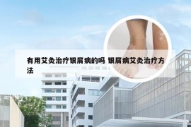 有用艾灸治疗银屑病的吗 银屑病艾灸治疗方法