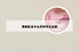 黄精配合什么药材可以治癣
