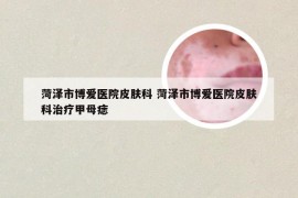 菏泽市博爱医院皮肤科 菏泽市博爱医院皮肤科治疗甲母痣