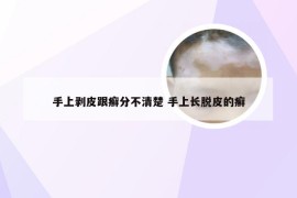 手上剥皮跟癣分不清楚 手上长脱皮的癣