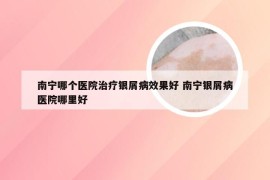 南宁哪个医院治疗银屑病效果好 南宁银屑病医院哪里好