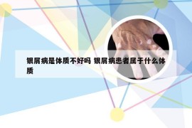 银屑病是体质不好吗 银屑病患者属于什么体质