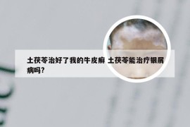 土茯苓治好了我的牛皮癣 土茯苓能治疗银屑病吗?
