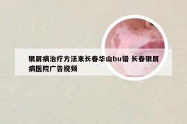 银屑病治疗方法来长春华山bu错 长春银屑病医院广告视频