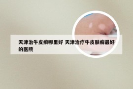 天津治牛皮癣哪里好 天津治疗牛皮肤癣最好的医院
