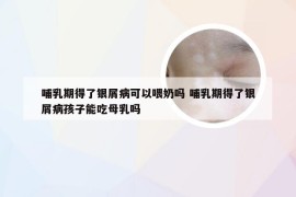 哺乳期得了银屑病可以喂奶吗 哺乳期得了银屑病孩子能吃母乳吗
