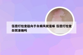 伍德灯检查趋向于白癜风就是嘛 伍德灯检查白斑准确吗