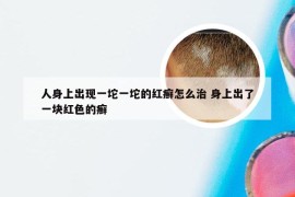 人身上出现一坨一坨的红癣怎么治 身上出了一块红色的癣